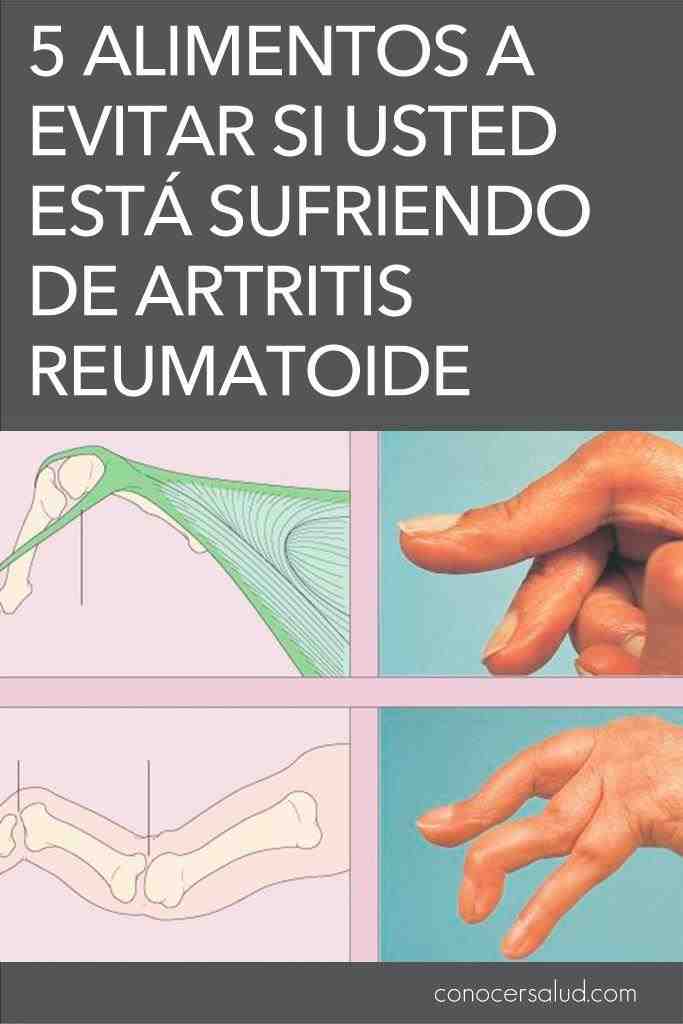 5 alimentos para evitar se você está sofrendo de artrite reumatoide 5 alimentos para evitar se você está sofrendo de artrite reumatoide