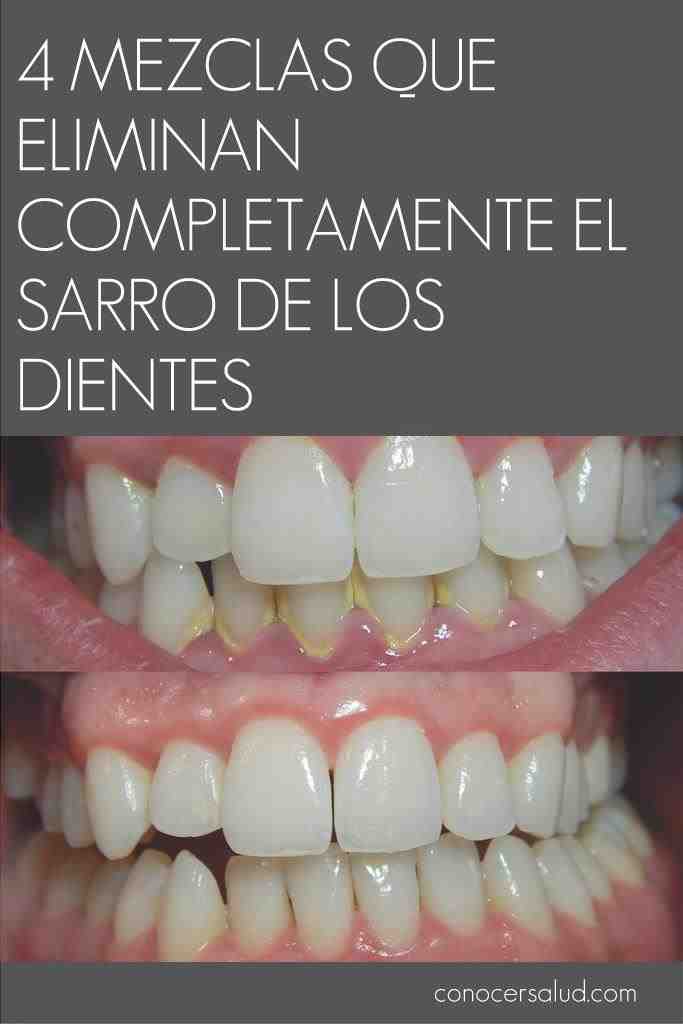 4 misturas que eliminam completamente os tártaros dos dentes 4 misturas que eliminam completamente os tártaros dos dentes