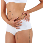 O que você faz antes da lipoaspiração realmente importa