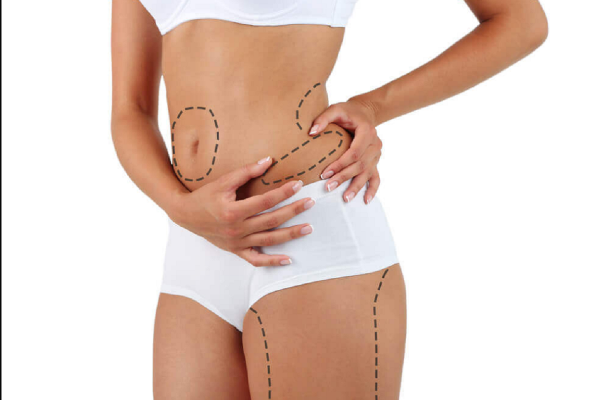 O que você faz antes da lipoaspiração realmente importa